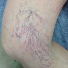 SPIDER VEINS